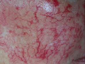 Telangiectasia