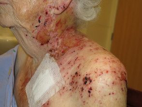 figure-6-feverrash2__protectwyjqcm90zwn0il0_focusfillwzi5ncwymjisingildfd-2107069-7513990