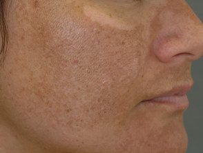 Melasma