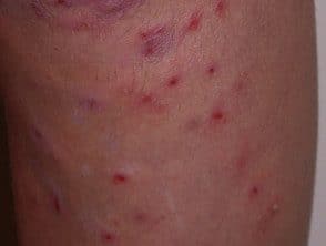 Dermatitis infectada