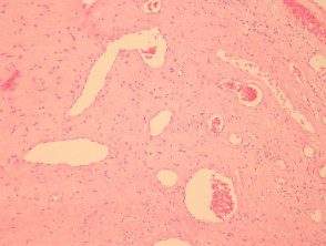 giant-cell-fibroblastoma-fig-1__protectwyjqcm90zwn0il0_focusfillwzi5ncwymjisingildfd-3024631-2149022