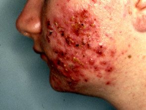 Foliculitis gramnegativa