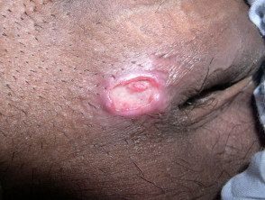 Granuloma inguinal