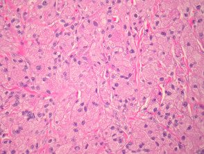 granular-cell-tumour-figure-1__protectwyjqcm90zwn0il0_focusfillwzi5ncwymjisingildfd-4963337-1517311
