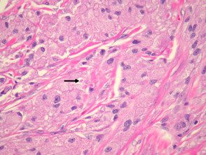 granular-cell-tumour-figure-2__protectwyjqcm90zwn0il0_focusfillwzi5ncwymjisingildfd-4517751-5051567