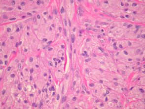granular-cell-tumour-figure-3__protectwyjqcm90zwn0il0_focusfillwzi5ncwymjisingildfd-3420915-3488952