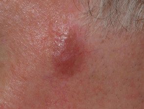 Granuloma facial