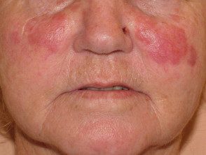 Granuloma facial