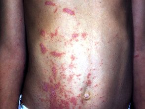 dermatitis por grevillea