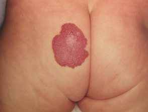 Hemangioma