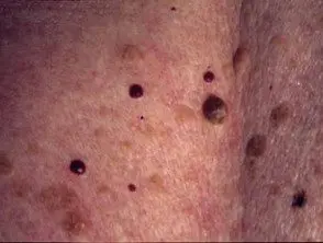 Angiomas de cereza