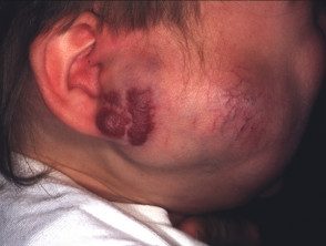 Hemangioma