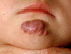 Hemangioma