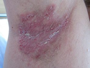 Joserra on X: Dermatitis en axila que no mejora tras antifúngico  tópico.Pensar en intértrigo estreptocócico    / X