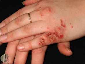 Dermatitis de la mano infectada