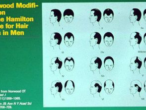 La clasificación de Norwood de la alopecia de patrón masculino