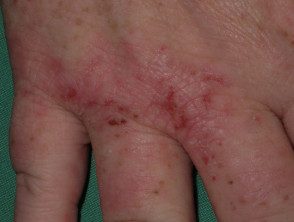 dermatitis de mano en paciente con antiTNF