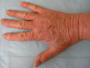 Dermatitis de manos por alergia de contacto al tiuram en guantes de goma.