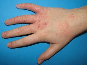 hand-dermatitis1__protectwyjqcm90zwn0il0_focusfillwzi5ncwymjisingildfd-2720007-9628485