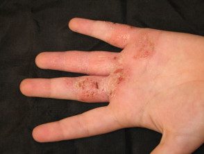 hand-dermatitis2__protectwyjqcm90zwn0il0_focusfillwzi5ncwymjisingildfd-9962186-3412680