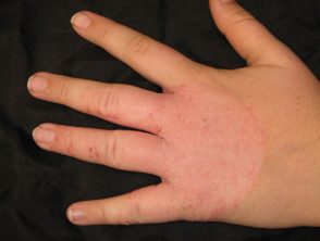 hand-dermatitis3__protectwyjqcm90zwn0il0_focusfillwzi5ncwymjisingildfd-7928921-7760906