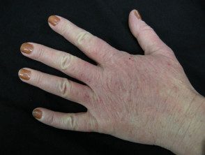 hand-dermatitis5__protectwyjqcm90zwn0il0_focusfillwzi5ncwymjisingildfd-7907215-7472161