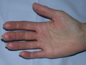 Dermatitis de la mano