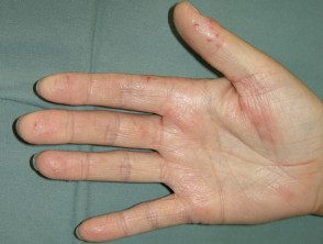 Dermatitis de la mano