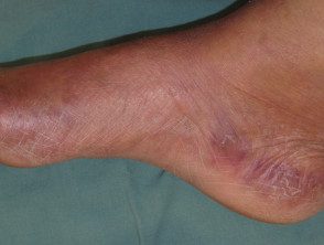 Síndrome de pies y manos debido a la quimioterapia.