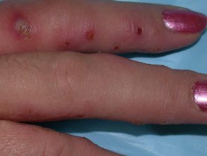 Dermatitis vesicular infectada de la mano