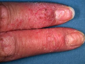 Dermatitis de la mano