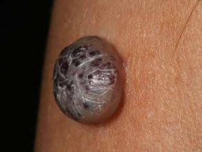 Hemangioma parecido al melanoma nodular