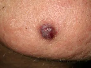 Hemangioma