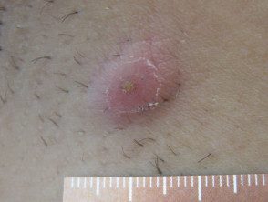 Nódulo de hidradenitis