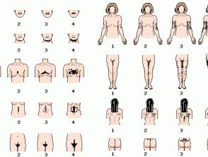 Hirsutisme - Hoogstra - Centres Médicaux