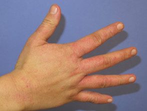 Dermatitis de la mano ama de casa