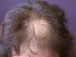 Alopecia de patrón femenino