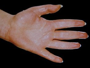 Hiperhidrosis palmar