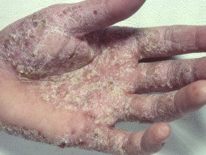 hyperkeratotic-hand-dermatitis-02__protectwyjqcm90zwn0il0_focusfillwzi5ncwymjisingildfd-1061299-4041031