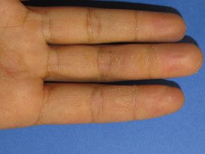 hyperkeratotic-hand-dermatitis-03__protectwyjqcm90zwn0il0_focusfillwzi5ncwymjisingildfd-2401810-9725208