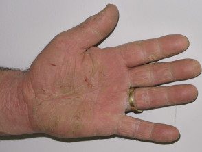 hyperkeratotic-hand-dermatitis-07__protectwyjqcm90zwn0il0_focusfillwzi5ncwymjisingildfd-8833830-5034146