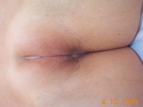 Hiperpigmentación hormonal. 5 días de crema de estrógenos 