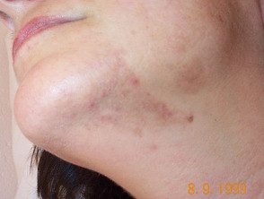 Hiperpigmentación posinflamatoria debido al acné