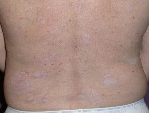 Hipopigmentación posinflamatoria: cirugía y crioterapia para múltiples cánceres de piel