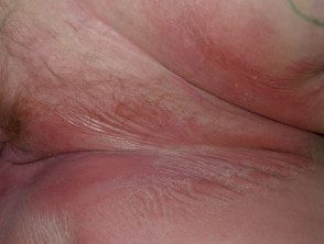Dermatitis inducida por incontinencia