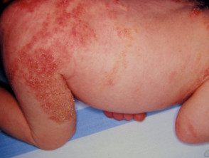 Incontinentia pigmenti en un neonato