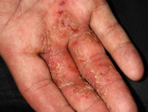 Dermatitis vesicular infectada de la mano