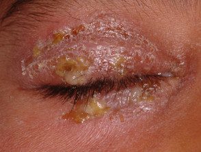 infected-eczema-01__protectwyjqcm90zwn0il0_focusfillwzi5ncwymjisingildiwxq-9409128-1648142