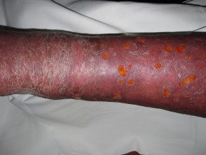 Celulitis e insuficiencia venosa