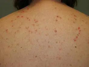 Dermatitis inducida por inyecciones de inmunoglobulina.